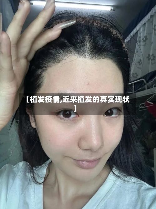 【植发疫情,近来植发的真实现状】-第2张图片