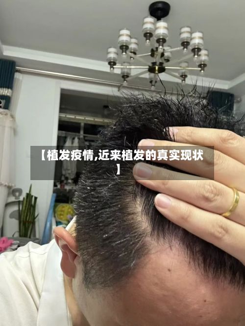 【植发疫情,近来植发的真实现状】-第3张图片